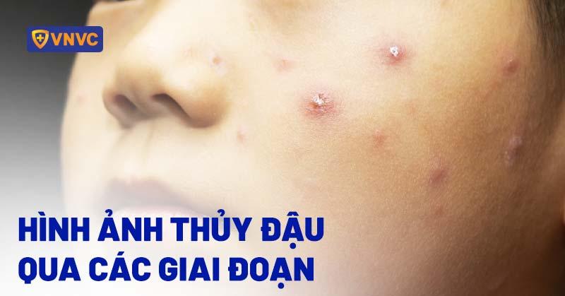 hình ảnh thủy đậu